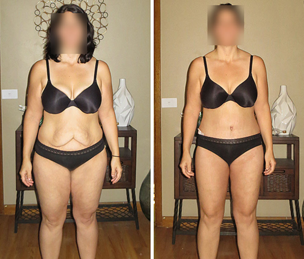 The Abdominal Panniculectomy vs Tummy Tuck in the Extreme Weight Loss  Patient - Explore Plastic Surgery