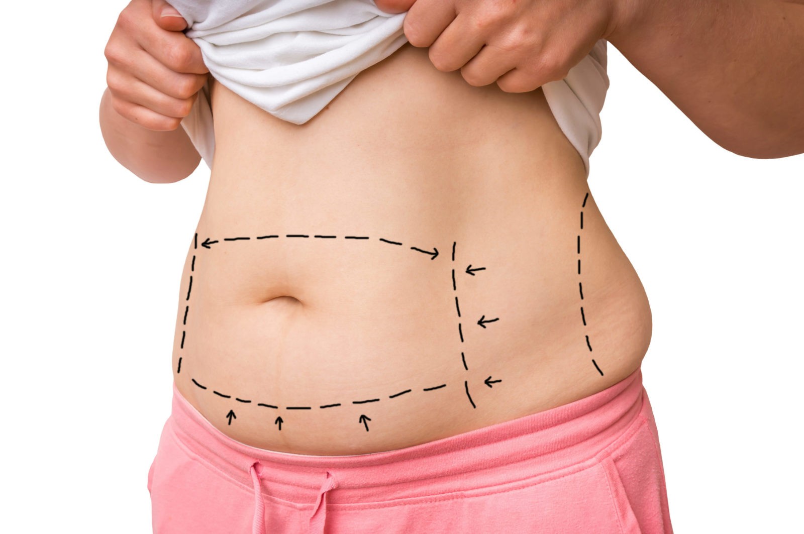 Your Tummy Tuck Recovery Timeline - Center for Plastic Surgery