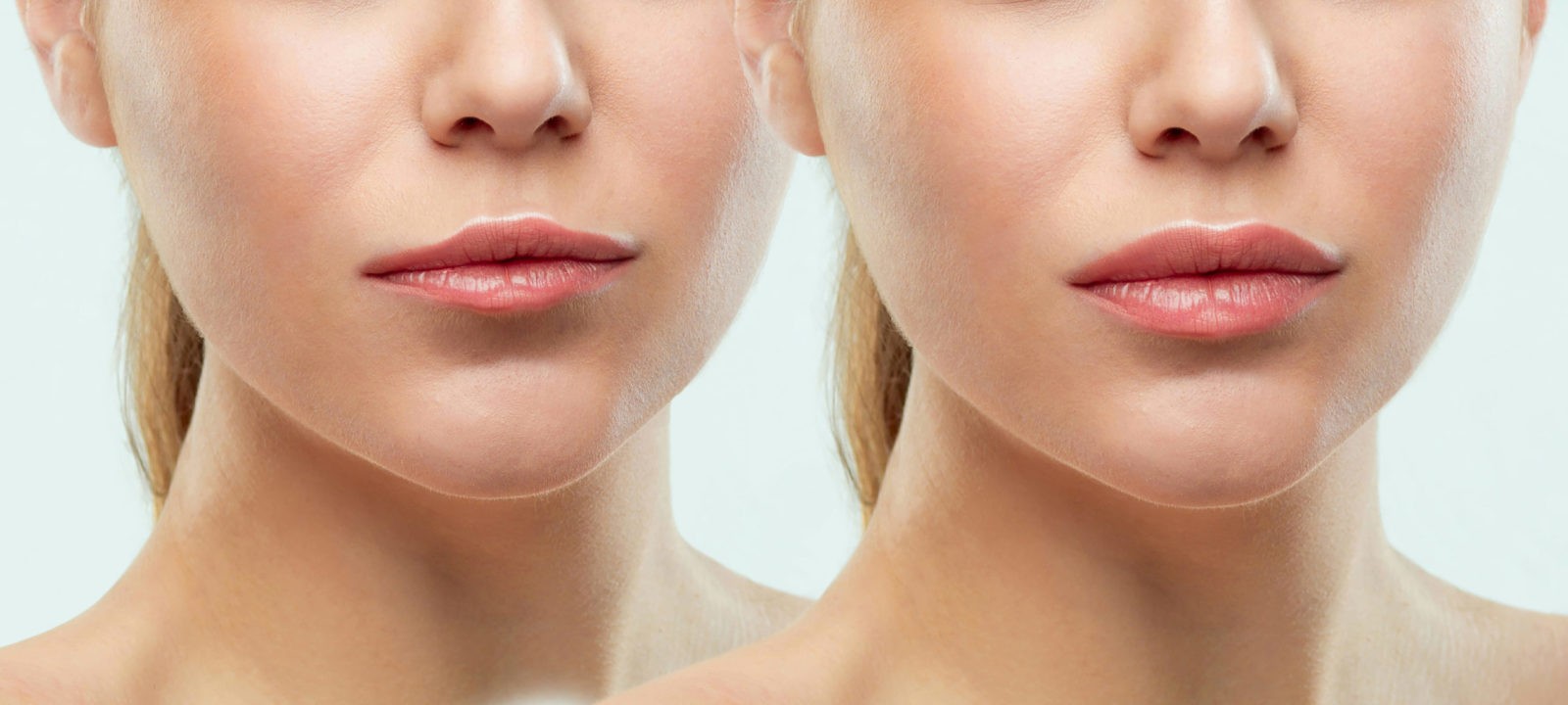 The Main Principles Of What Is Juvederm® Used For? - Ageless Rejuvenation Center  thumbnail