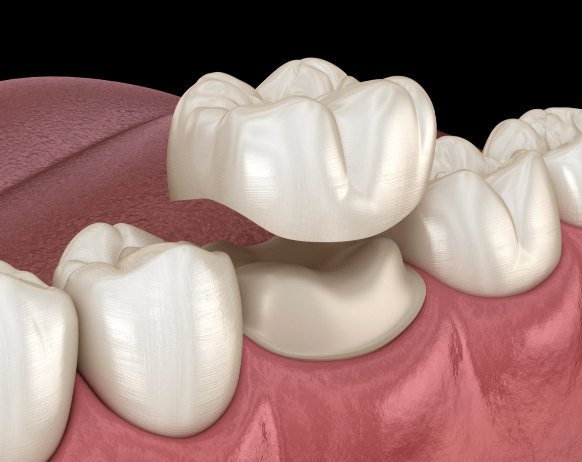 Should You Get Porcelain Crowns Tooth Crown 101 Vida