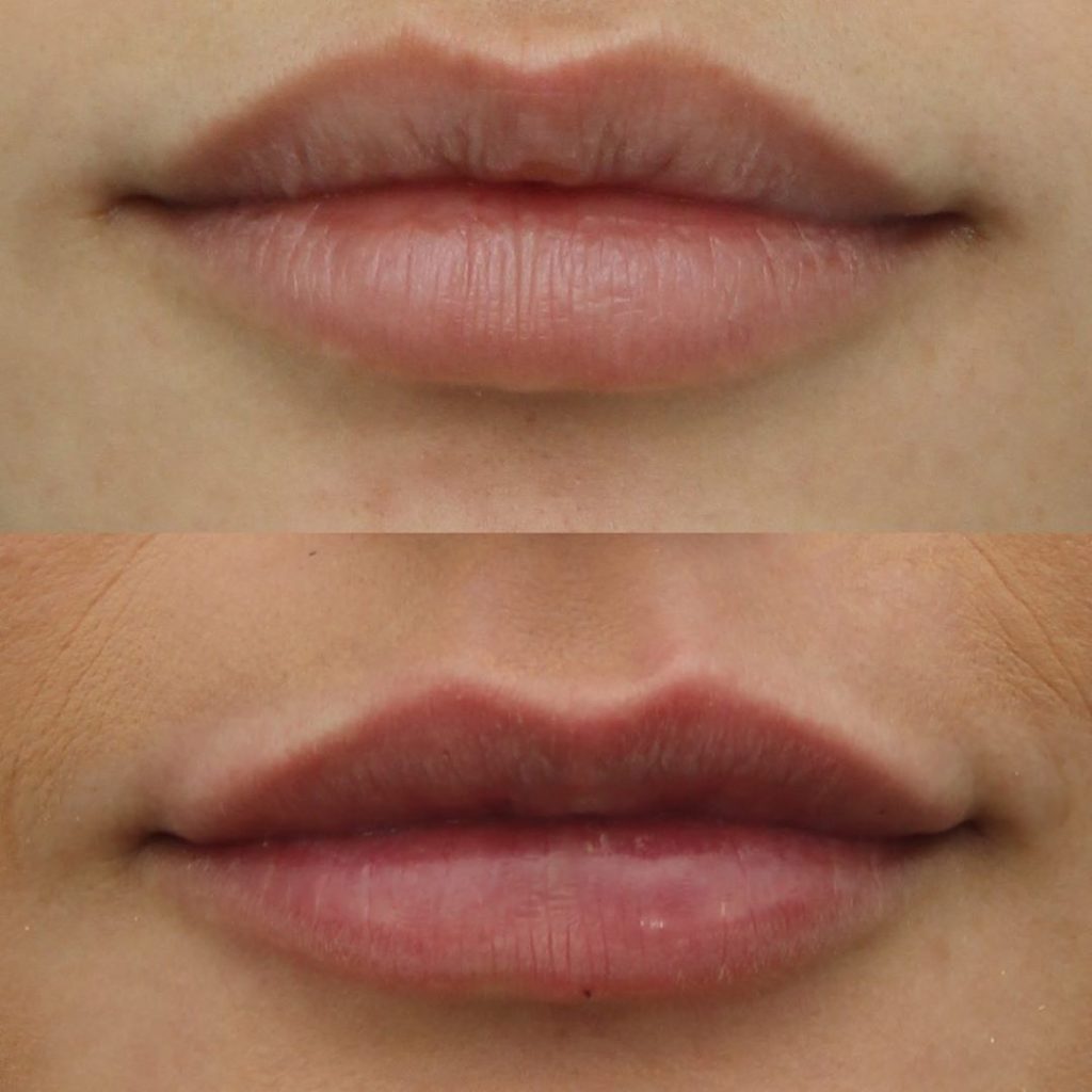 The Perfect Pair of Lips Injections, Fillers, and Augmentation VIDA