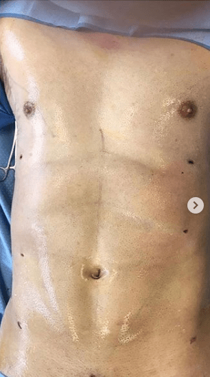 Abdominal Etching Six Packs Examples (and How It Works) - Cosmos Clinic