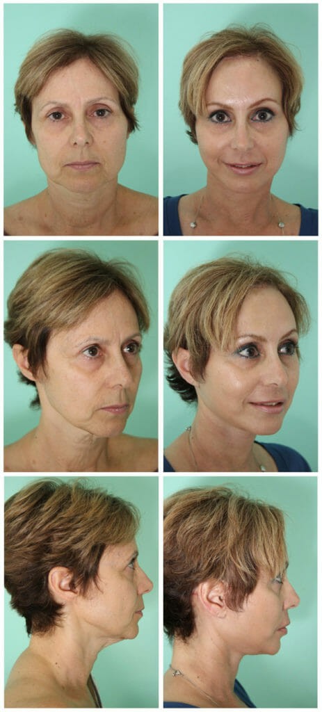 Lifting facial: ¿En qué consiste? Tratamiento y resultados