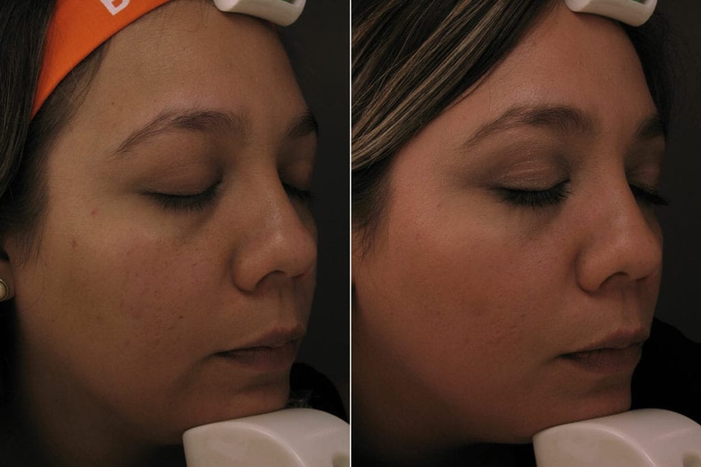laser treatment mexico before and after