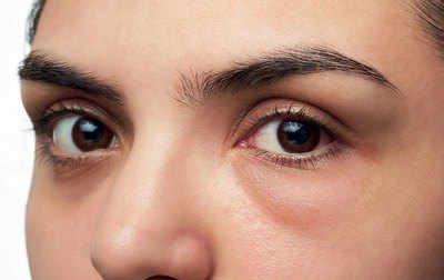 What Causes Puffy Eyes?