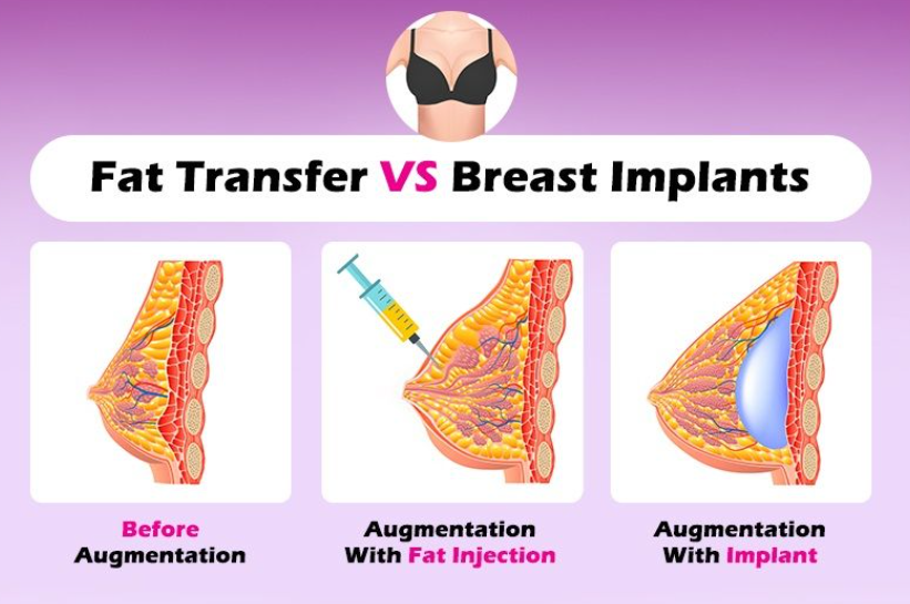 Fat Transfer After Breast Implant Removal