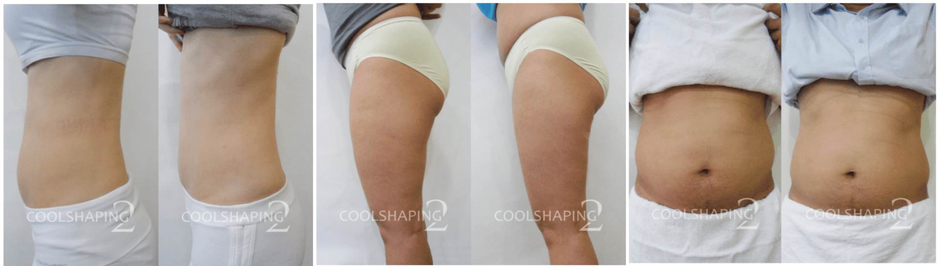 coolshaping 2 before and after pictures