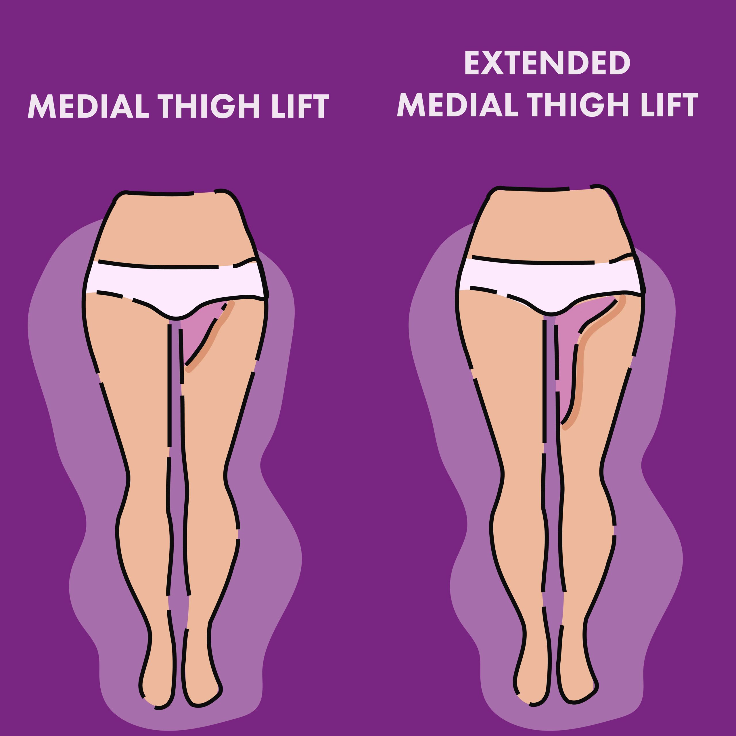 Is Inner Thigh Lift Worth It? Recovery, Scars, Results, and More
