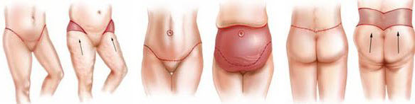 FAQs about Tummy Tuck and Lower Body Lift