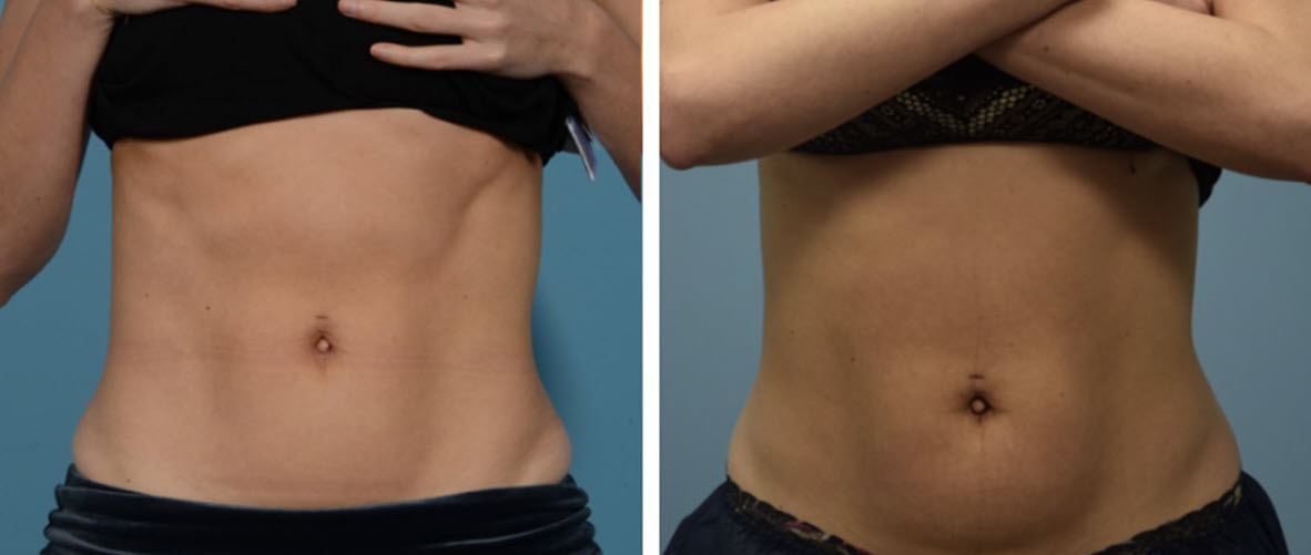 How To Incorporate Noninvasive Body Sculpting To Achieve Your Body Goals 