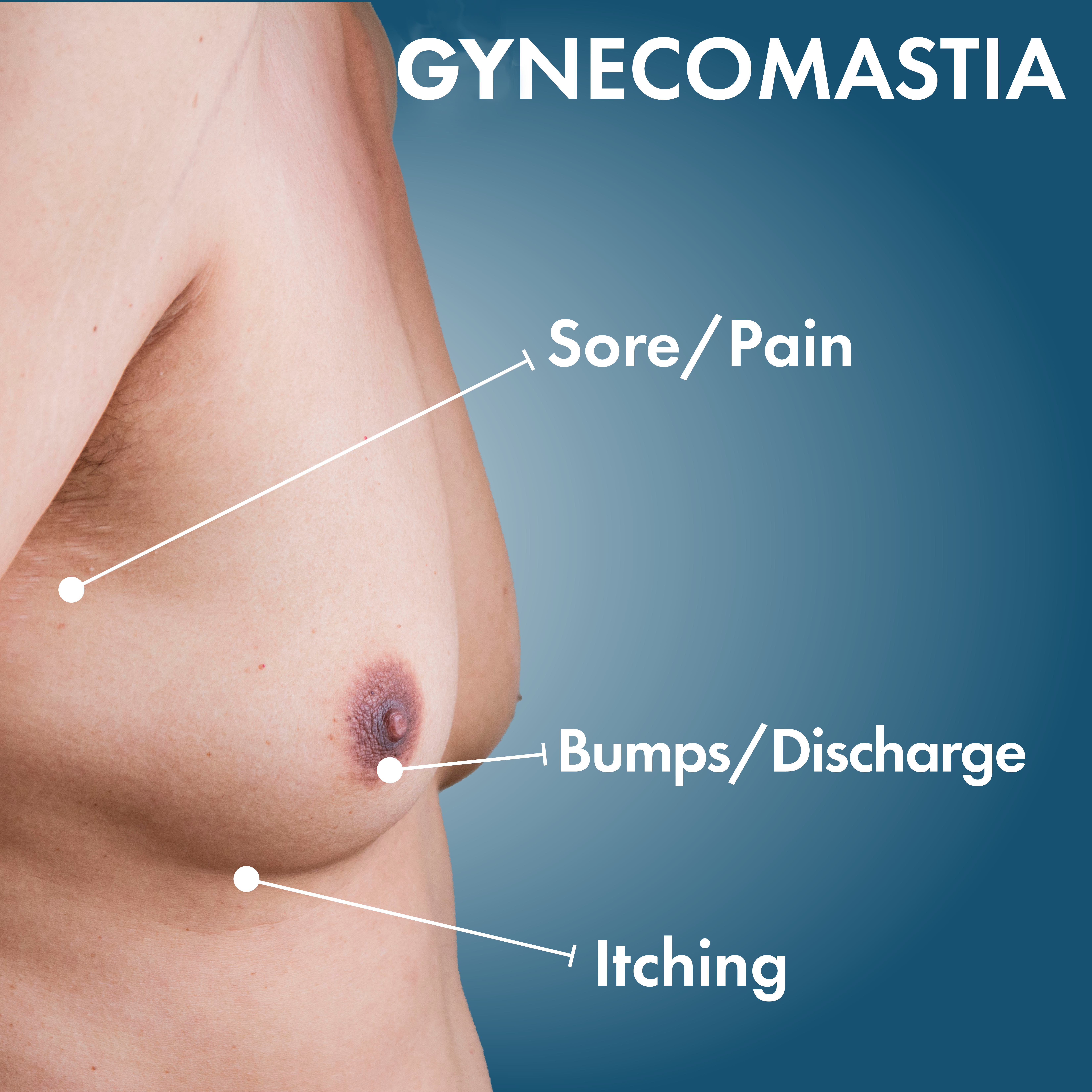 Gynecomastia: Surgery, treatment, causes, and symptoms