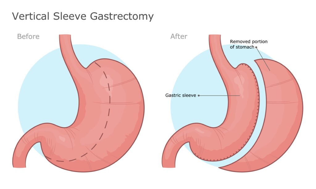 Before and after gastric sleeve surgery.