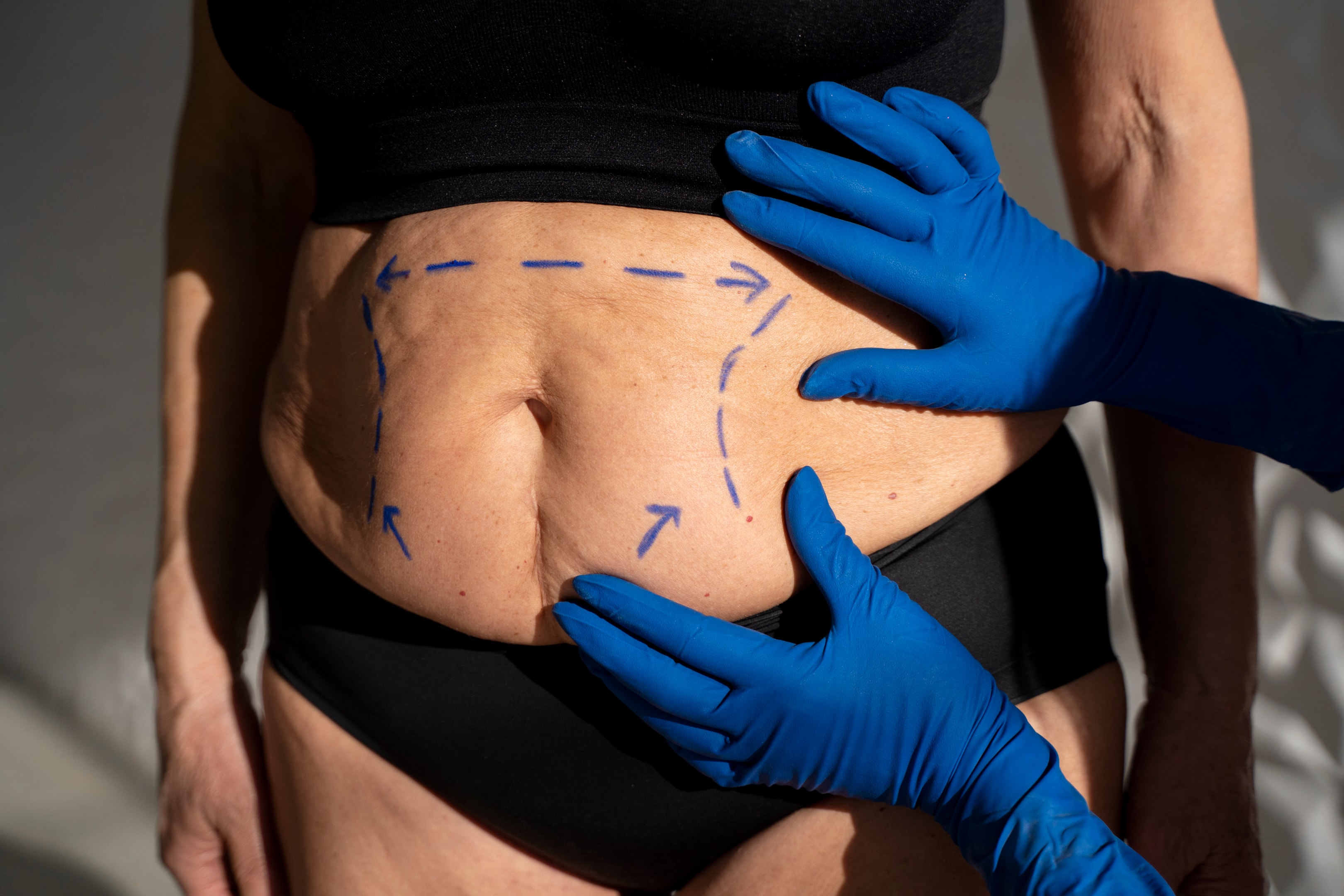 Abdomen of woman marked by plastic surgeon