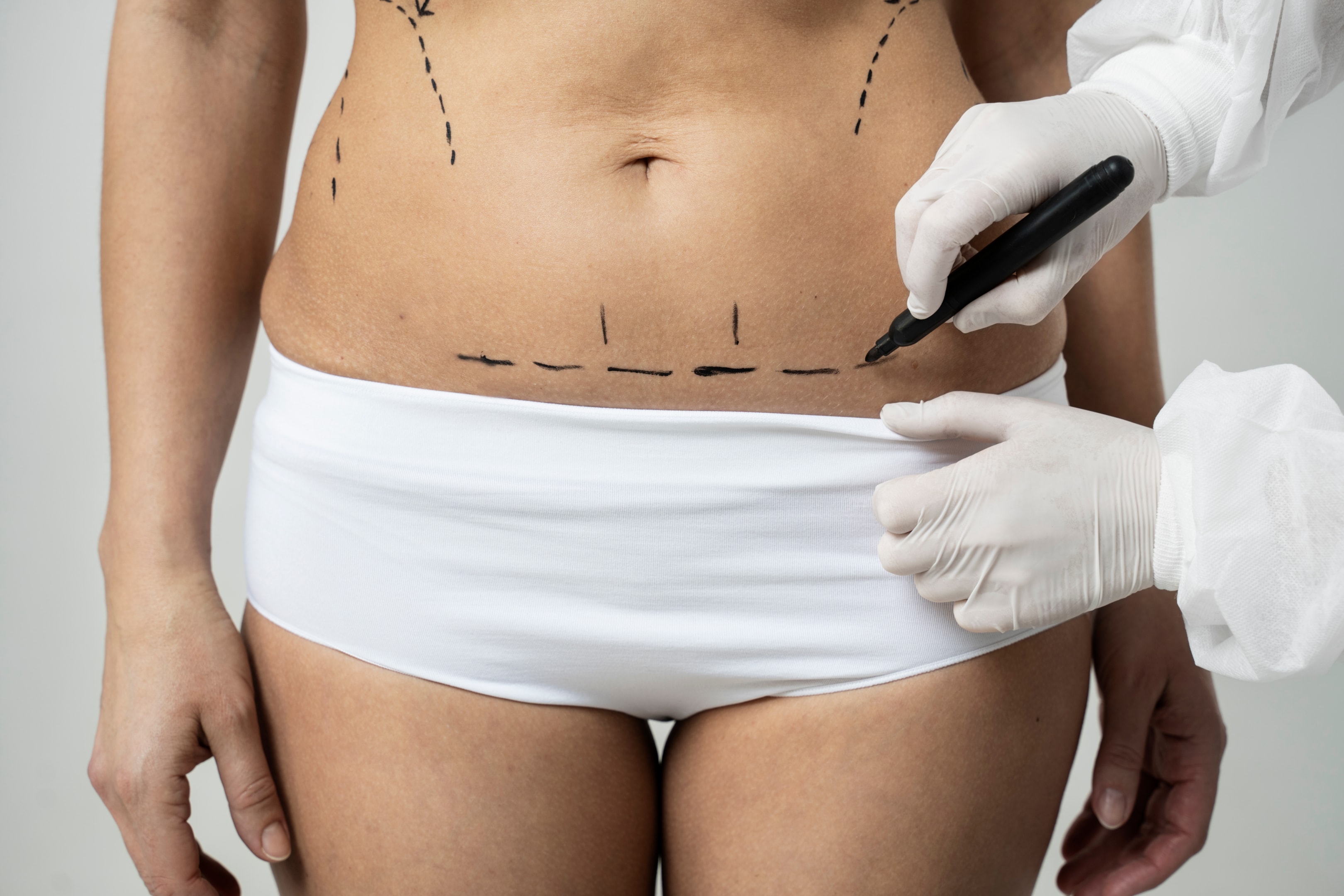 Abdomen of woman marked by plastic surgeon preparing her for surgery.