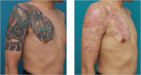 Non-Laser Tattoo Removal Methods