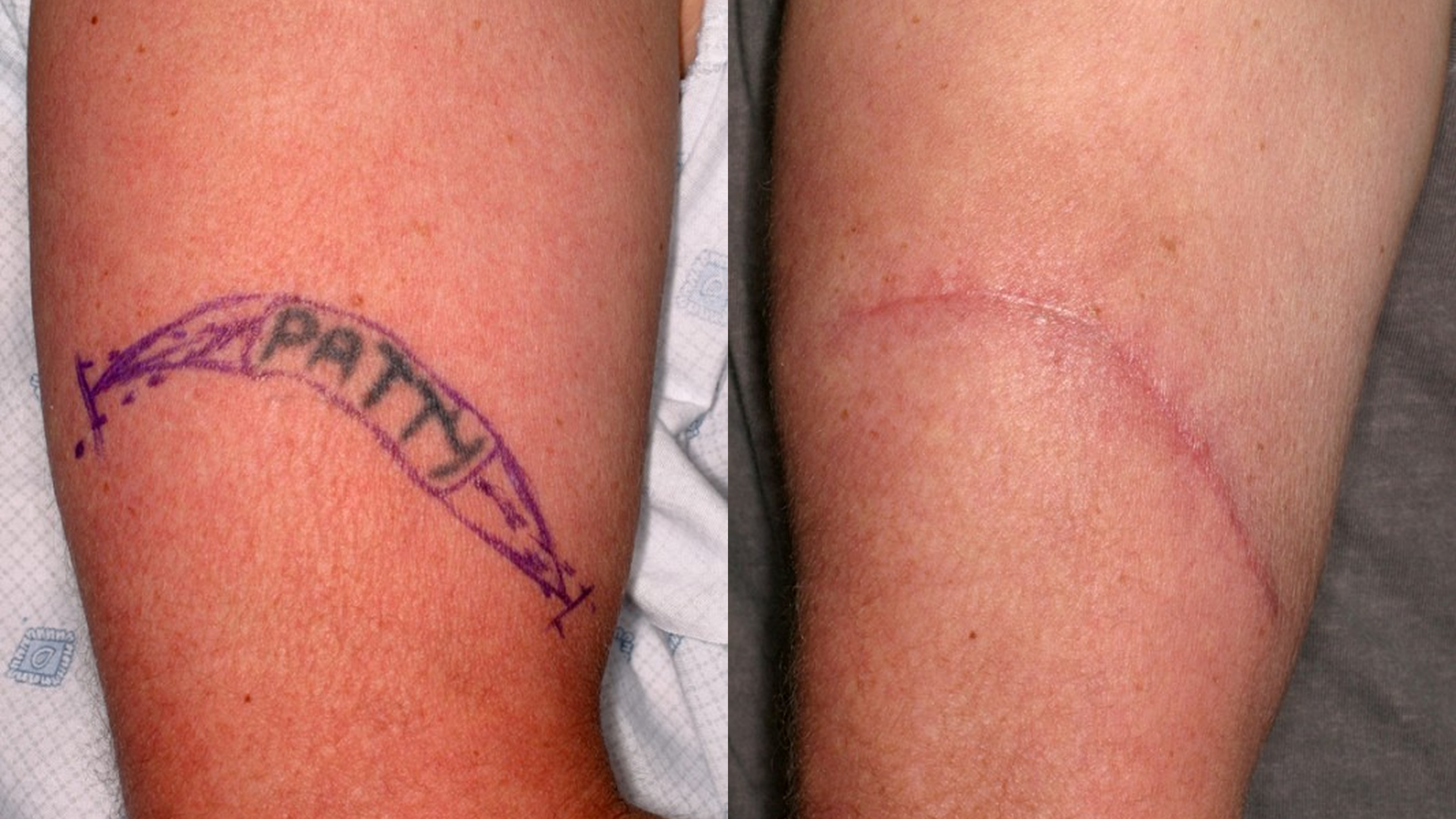 Tattoo Surgical Excision