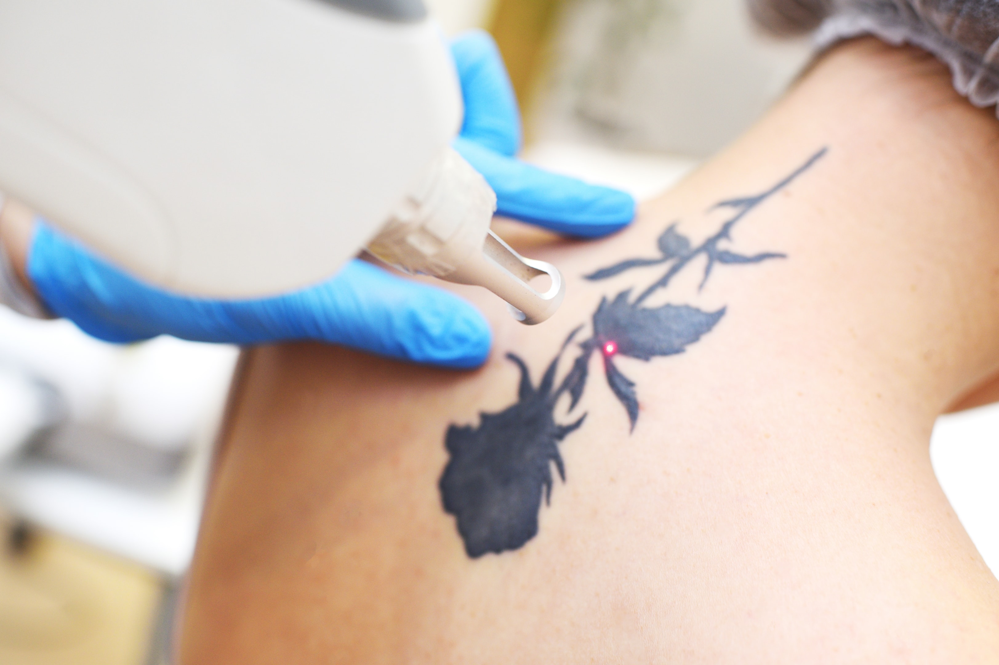 Laser removal targets individual ink particles and breaking them down into smaller chunks