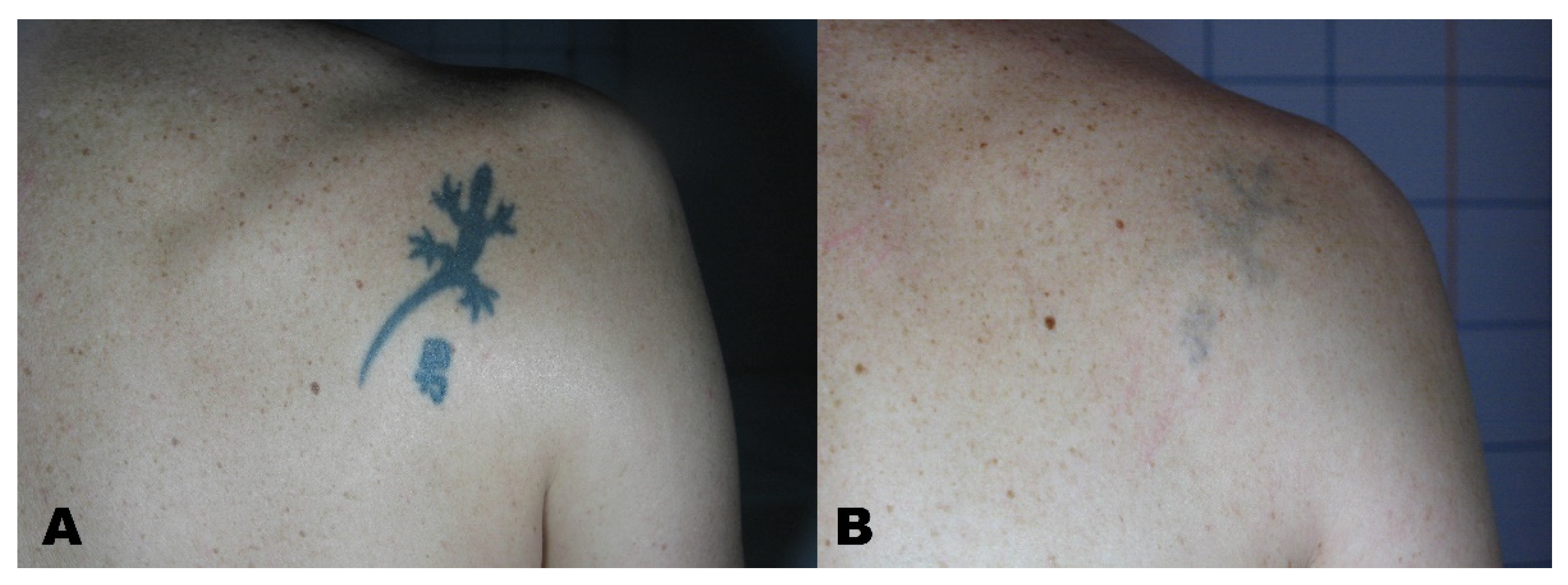 Q-switched alexandrite laser tattoo removal