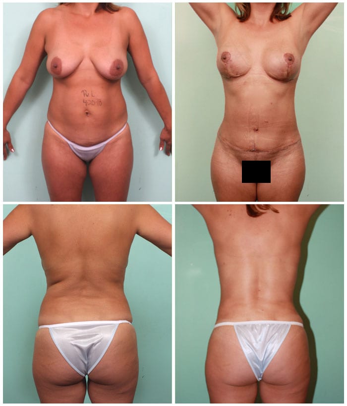Mothers-Day-Mommy-Makeover-Mom-Bod - Medilaser Surgery and Vein Center