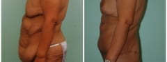 Body Lift Revision Surgery