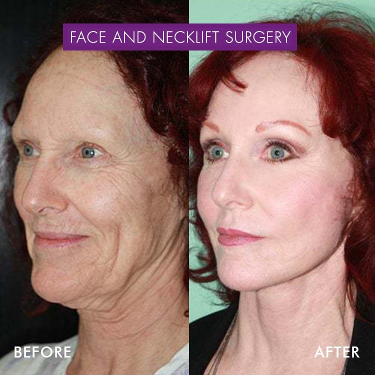 Types of Facelift Incisions: What To Expect & Which Is Best For